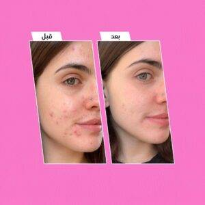 Acne and Pimples Face Patch لاصقة حب الشباب وبثور الوجه